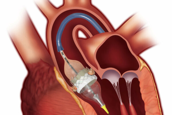 EISENHOWER HEALTH FIRST IN CALIFORNIA TO COMPLETE EDWARDS BENCHMARK™ PROGRAM FOR TRANSCATHETER AORTIC VALVE REPLACEMENT (TAVR) ONLY HOSPITAL IN COACHELLA VALLEY TO OFFER TAVR